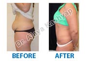 Abdominoplasty